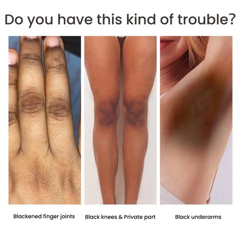 PigmentEase Skin Solution